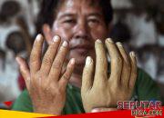 Dari Bali ke Bukares: Kisah Kusta, Migrasi, dan Stigma yang Tak Pernah Pergi